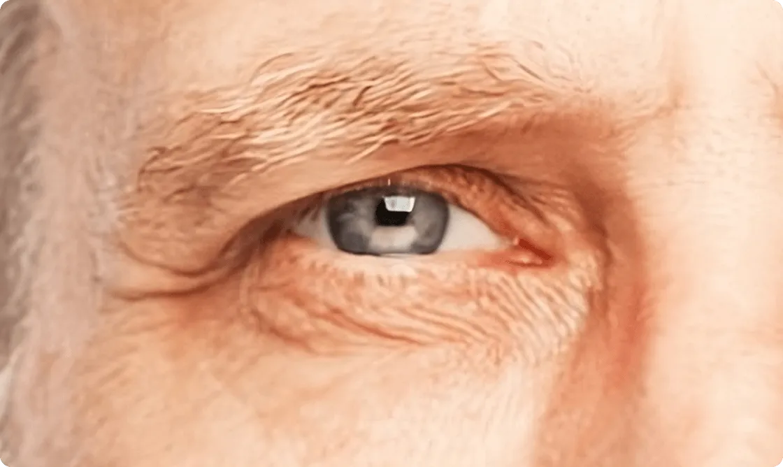 A close up photo of an elderly patients eye